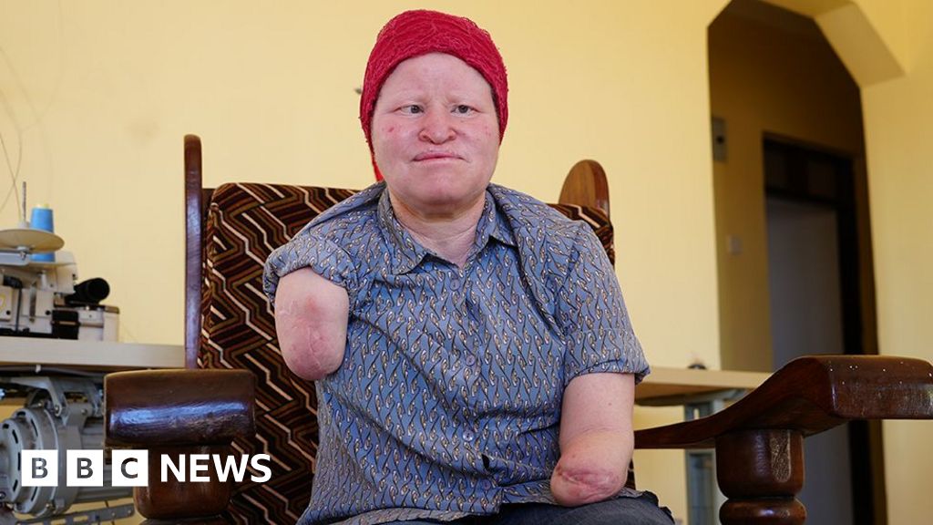 The fears that voting time brings for those with albinism